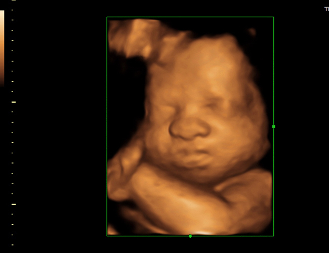 3D ultrasound image at 29 weeks